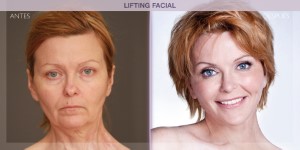Before and after image of a face lift procedure.